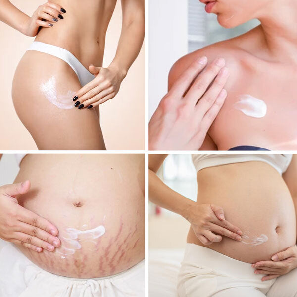 Feenle Natural Stretch Mark Removal Cream 100g