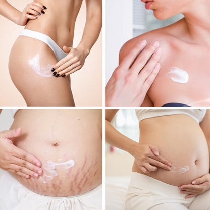 Feenle Natural Stretch Mark Removal Cream 100g